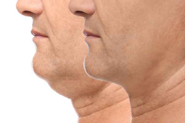 HIFU - Breakthrough in Anti - ageing 2 hifu results Purfleet