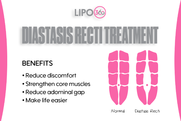 Revolutionising Muscle Repair: The Power of LIPO360 Body Sculpt Post-Injury 5 diastasis recti treatment Purfleet