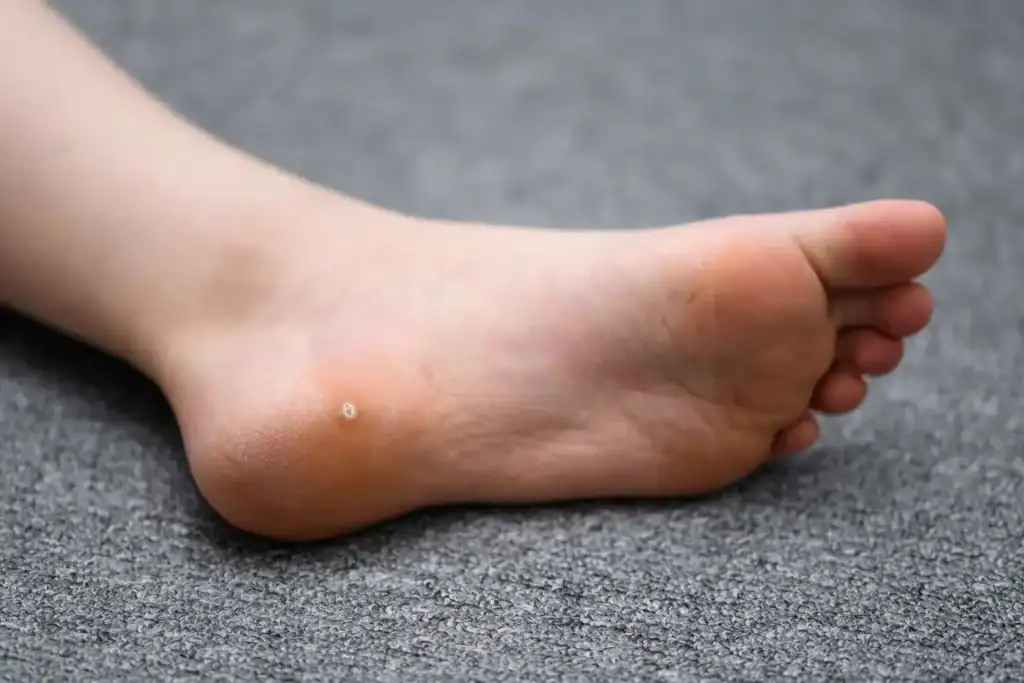 Cryotherapy For Warts And Also Verrucas 2 Image of verruca on the bottom of the foot that able to be treated with Cryotherapy Purfleet