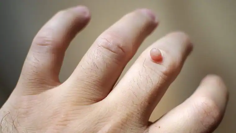 Image of blemish that Cryotherapy Purfleet can remove with Lipo 360.