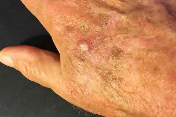 Cryopen For Actinic Keratoses 1 Image of Actinic keratoses Purfleet on a person hand